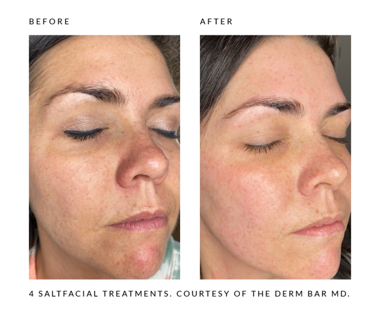 face-it-skin-saltfacial-ba-carousel4