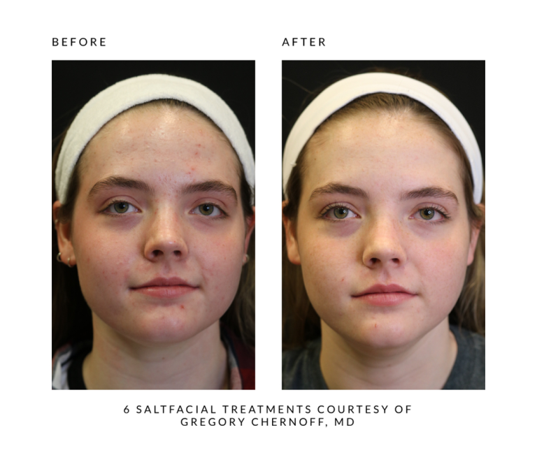 face-it-skin-saltfacial-ba-carousel5