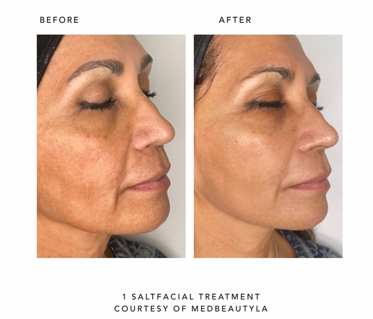 face-it-skin-saltfacial-ba-carousel6