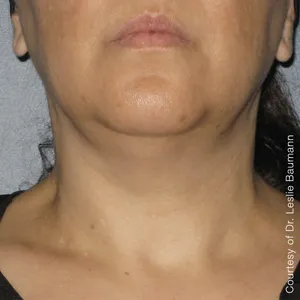 face-it-skin-ultherapy-0014-after-90day-neck