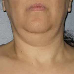 face-it-skin-ultherapy-0014-before-neck