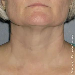 face-it-skin-ultherapy-0024-after-180day-neck