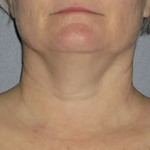 face-it-skin-ultherapy-0024-before-neck