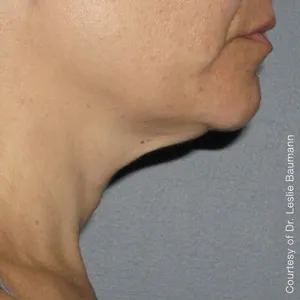 face-it-skin-ultherapy-0026-after-180day-neck