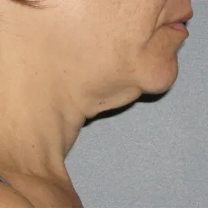 face-it-skin-ultherapy-0026-before-neck
